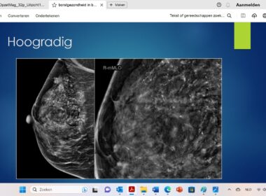 Studie toont veiligheid van waakzaam afwachten bij laaggradige DCIS 4