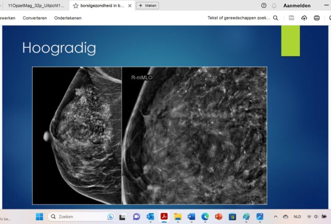 Studie toont veiligheid van waakzaam afwachten bij laaggradige DCIS 3